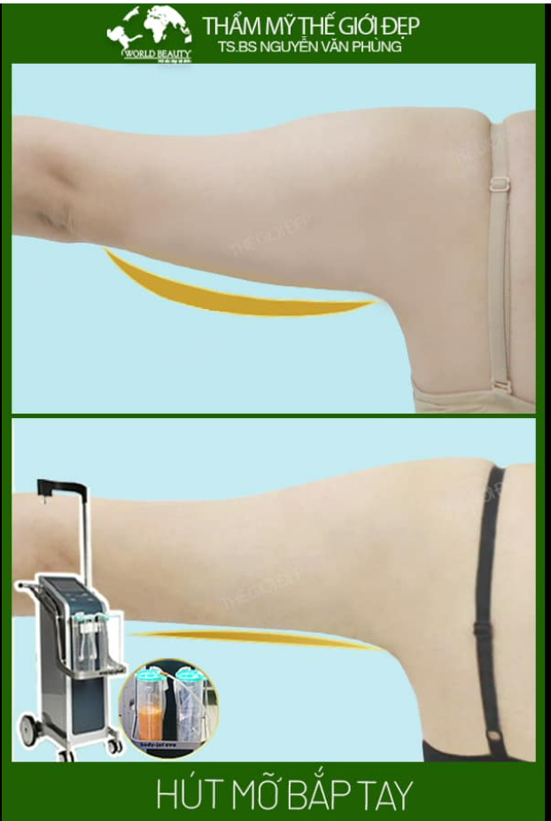 Tạo hình bắp tay thon thả - vóc dáng Nàng thêm yêu kiều, nữ tính bằng công nghệ Hút mỡ Body- jet- Evo