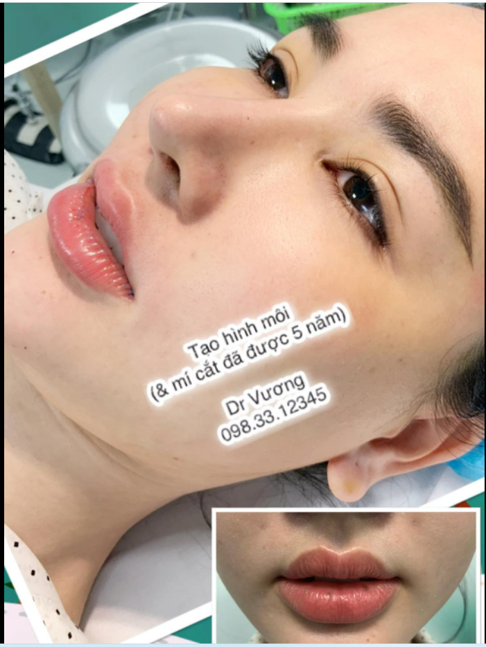 Tạo hình môi với Dr Vương !