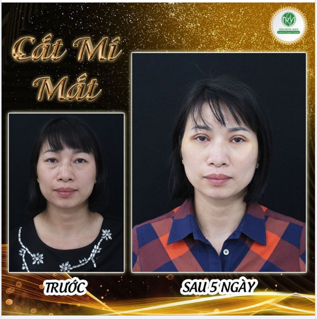 TẠO MẮT 2 MÍ CHO KH TUỔI TRUNG NIÊN