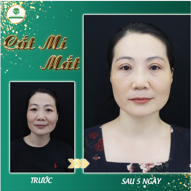 TẠO MẮT 2 MÍ - LẤY LẠI TUỔI XUÂN