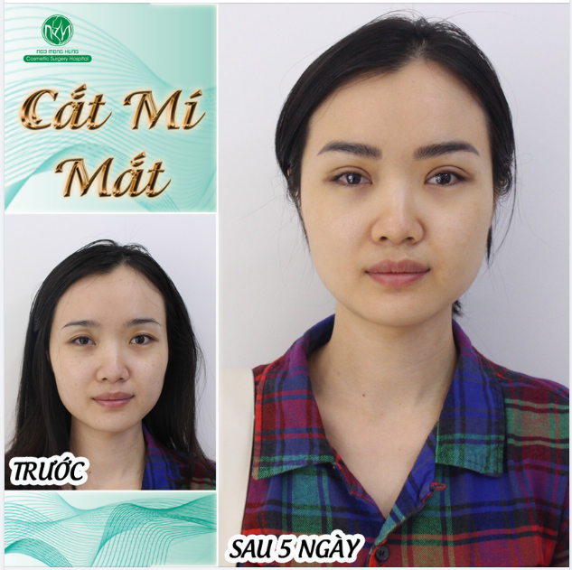 TẠO MẮT 2 MÍ TRẺ TRUNG - TĂNG NÉT THU HÚT CHO CỬA SỔ TÂM HỒN