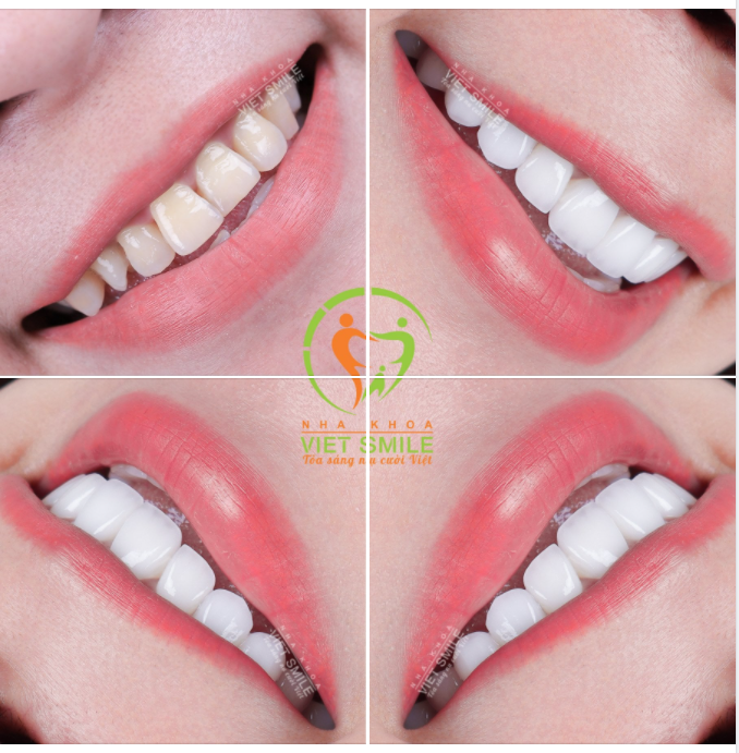 THẨM MỸ 21 RĂNG SỨ LAVA THỦ CÔNG KHẮC PHỤC RĂNG Ố VÀNG, HƠI CHÌA