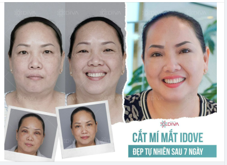 THẨM MỸ CẮT MÍ MẮT - ĐẸP TỰ NHIÊN SAU 7 NGÀY