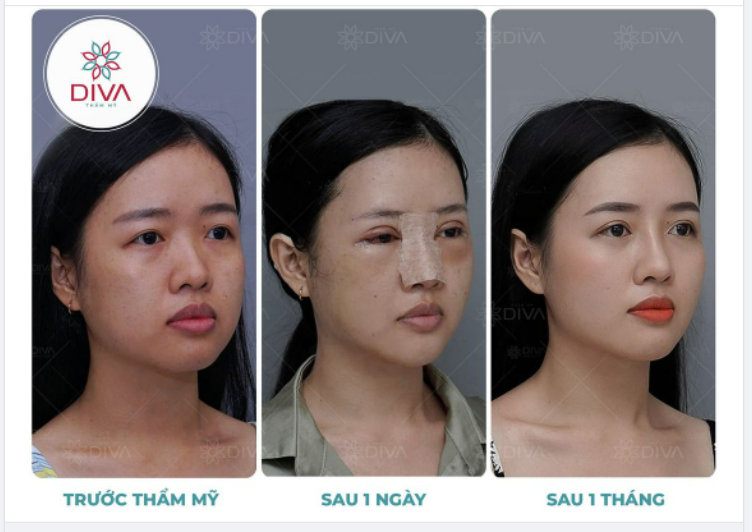 THẨM MỸ NÂNG MŨI – ĐÂU LÀ CÔNG ĐOẠN QUAN TRỌNG TẠO RA CHIẾC MŨI ĐẸP