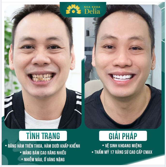 Thẩm mỹ răng sứ - Hoàn thiện nụ cười khoẻ đẹp