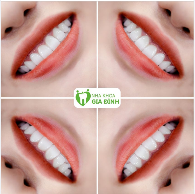 THẨM MỸ RĂNG SỨ - MẢNH GHÉP HOÀN HẢO CHO NỤ CƯỜI CỦA BẠN