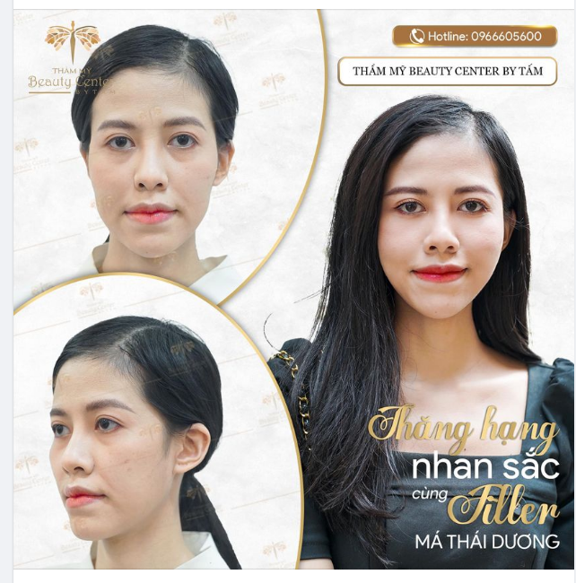 THĂNG HẠNG NHAN SẮC CŨNG FILLER MÁ THÁI DƯƠNG