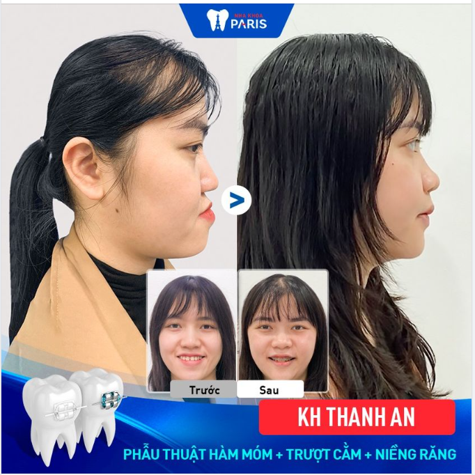 Thanh An - Cô gái với gương mặt hàm móm -  Khớp cắn hở.