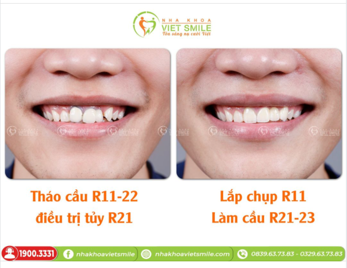 THÁO CẦU RĂNG 11-22 - LÀM LẠI CẦU RĂNG 21-23 CẢI THIỆN ĐEN CỔ CHÂN RĂNG