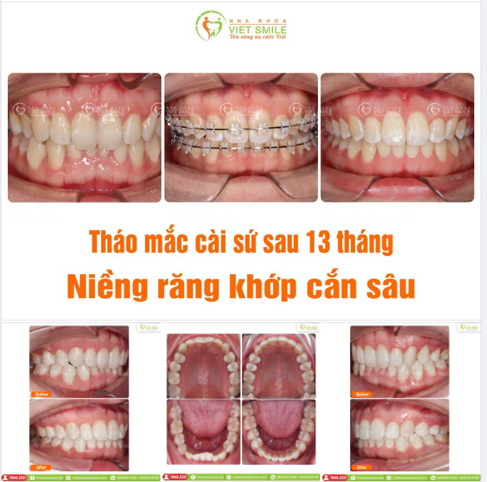 THÁO MẮC CÀI SỨ SAU 13 THÁNG NIỀNG RĂNG KHỚP CẮN SÂU