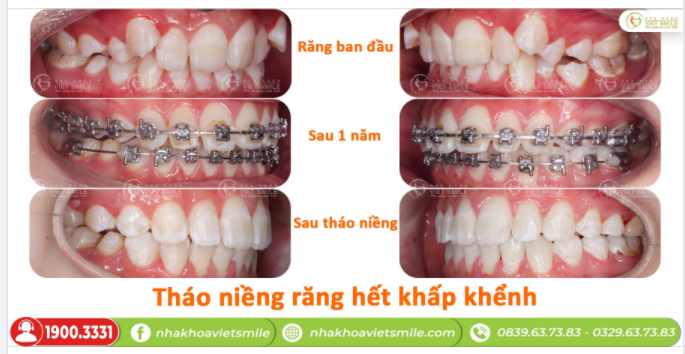 THÁO NIỀNG RĂNG HẾT KHẤP KHỂNH SAU 2,5 NĂM