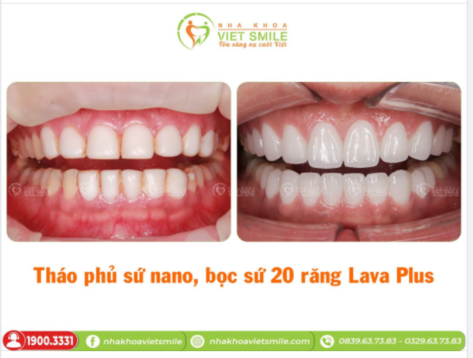 THÁO PHỦ SỨ NANO - BỌC SỨ 20 RĂNG LAVA PLUS