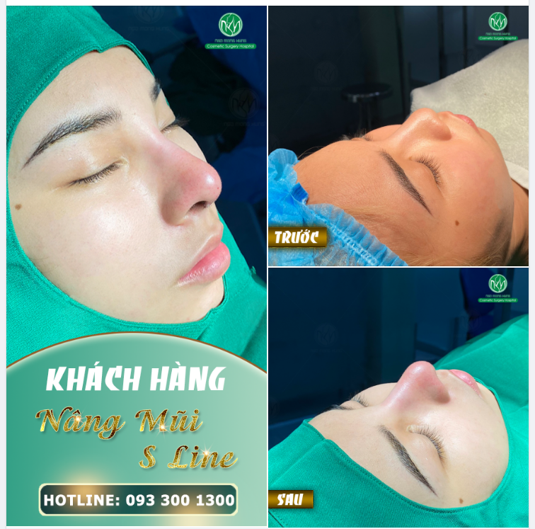 THAY ĐỔI HOÀN HẢO SAU KHI NÂNG MŨI S LINE