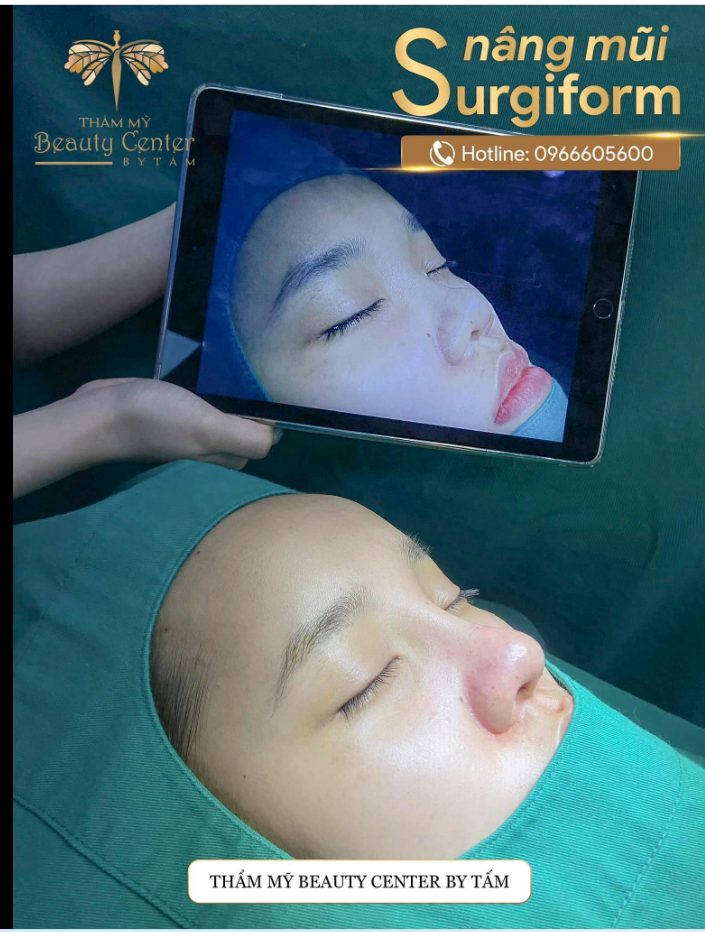 Thay đổi hoàn toàn sau nâng mũi