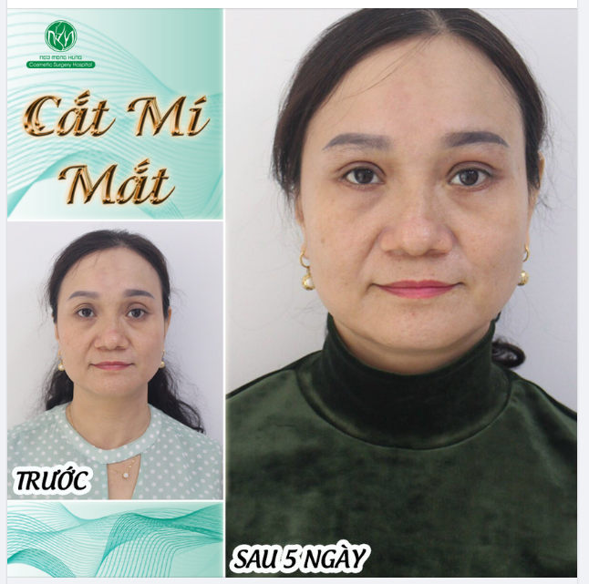 THAY ĐỔI NGỠ NGÀNG SAU 5 NGÀY CẮT MÍ