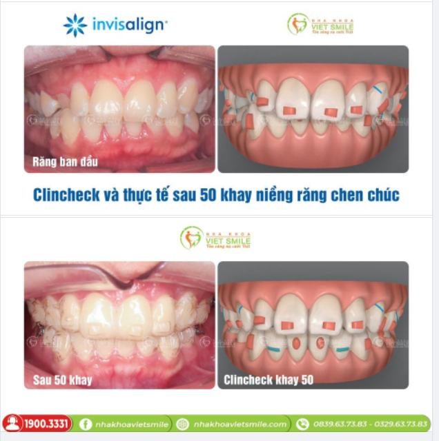 THAY ĐỔI SAU 50 KHAY NIỀNG INVISALIGN