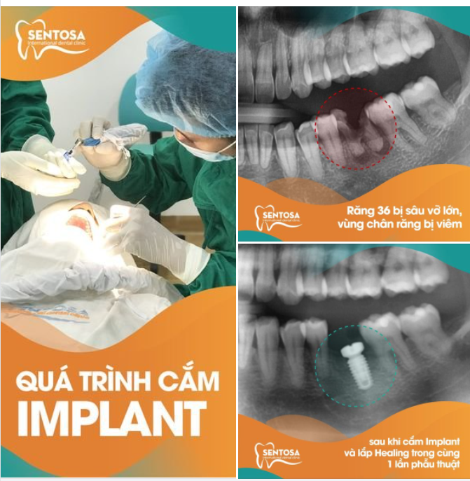 THAY THẾ CHIẾC RĂNG SÂU VỠ LỚN BỞI MỘT BẠN RĂNG IMPLANT CHẮC KHỎE