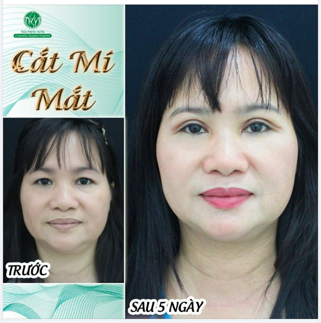 THÊM MỘT ĐÔI MẮT ĐẸP SAU CẮT MÍ MẮT