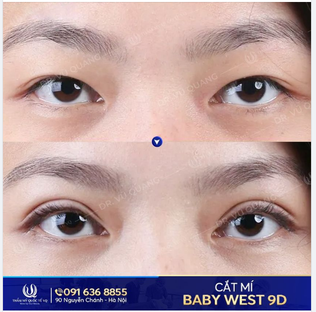 Thì ra..mắt đẹp...là do cắt mí Baby west 9D tại VQ