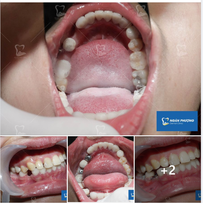 Thời hạn cuộc tình giữa trụ Implant và xương hàm lên đến 10 ngàn năm 
