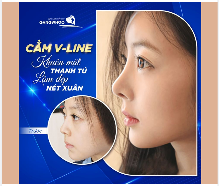 TIÊM FILLER CẰM VLINE - GIÚP KHUÔN MẶT THANH TÚ, LÀM ĐẸP NÉT XUÂN