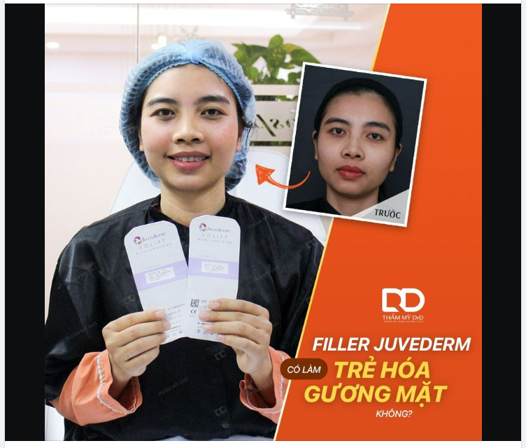 TIÊM FILLER JUVEDERM CÓ LÀM TRẺ HÓA GƯƠNG MẶT