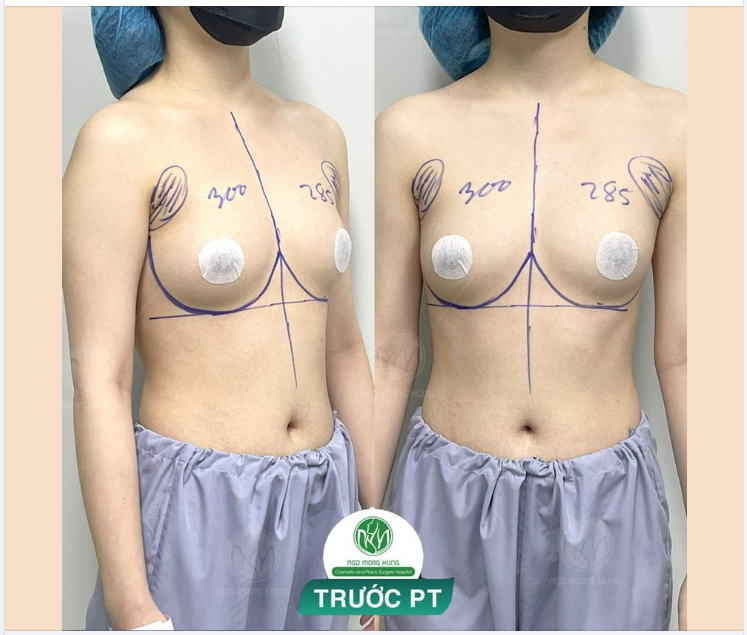 TIẾP NHẬN MỘT CA NÂNG NGỰC VÀO ĐẦU GIỜ CHIỀU