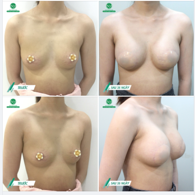 TIẾP TỤC CẬP NHẬT THÊM HÌNH ẢNH KH SAU 16 NGÀY NÂNG NGỰC