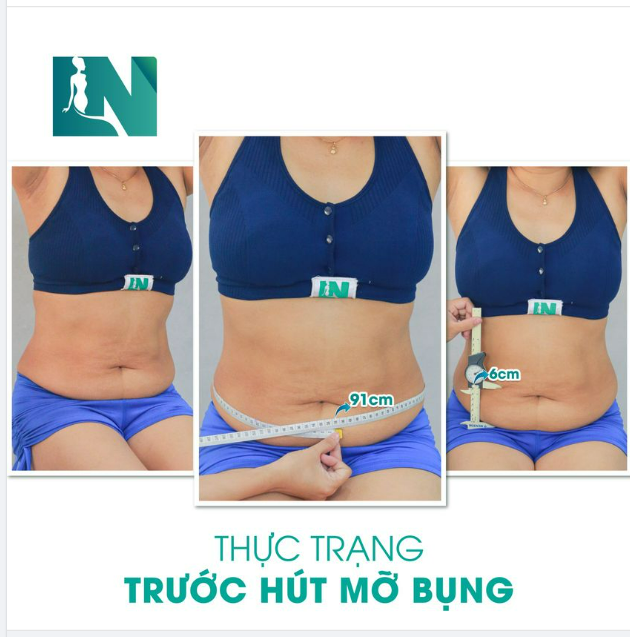 TÌM LẠI DÁNG VÓC THANH XUÂN, CÔ KH (50 TUỔI) Ở TPHCM LỰA CHỌN HÚT MỠ TẠO DÁNG THẨM MỸ