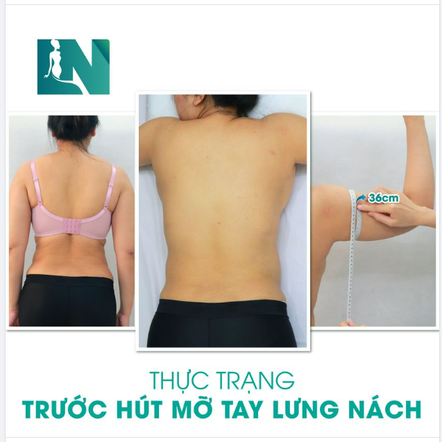 TÌM LẠI SỰ CÂN ĐỐI CHO DÁNG VÓC CỦA CHỊ KH (37 TUỔI) VỚI HÚT MỠ TẠO DÁNG THẨM MỸ VÙNG TAY, LƯNG, NÁCH 