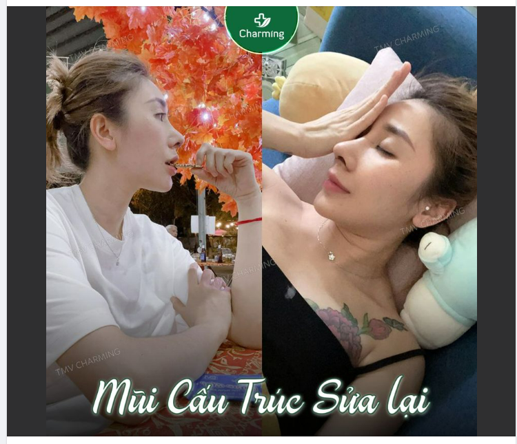 Tính em hay nôn nóng, muốn nâng mũi là đi nâng liền, nâng xong thấy đẹp, không cần đợi cắt chỉ, tháo băng là em phải chụp liền