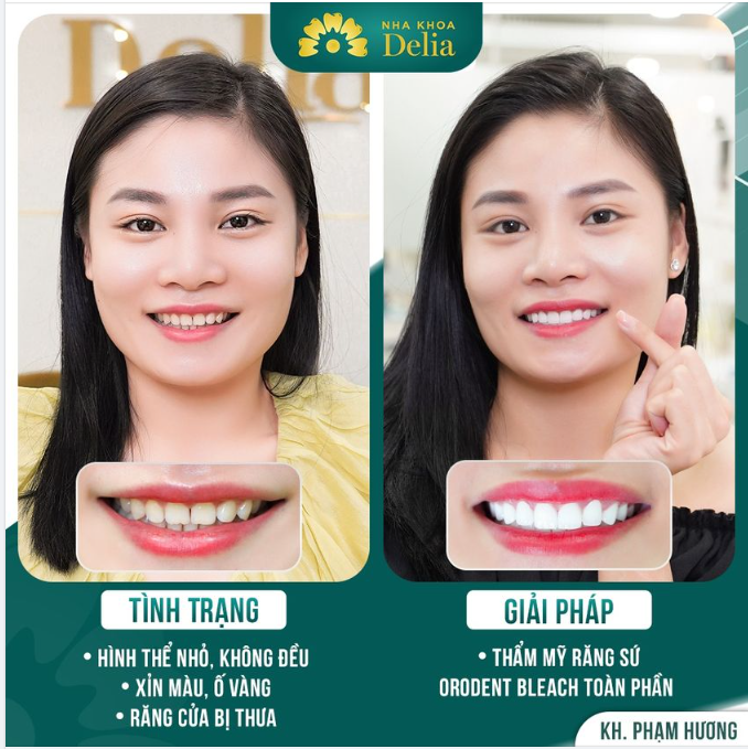 Tình trạng răng chị Hương trước khi đến Delia - Hình thể răng nhỏ, thưa nhẹ - Răng ố vàng, xỉn màu.