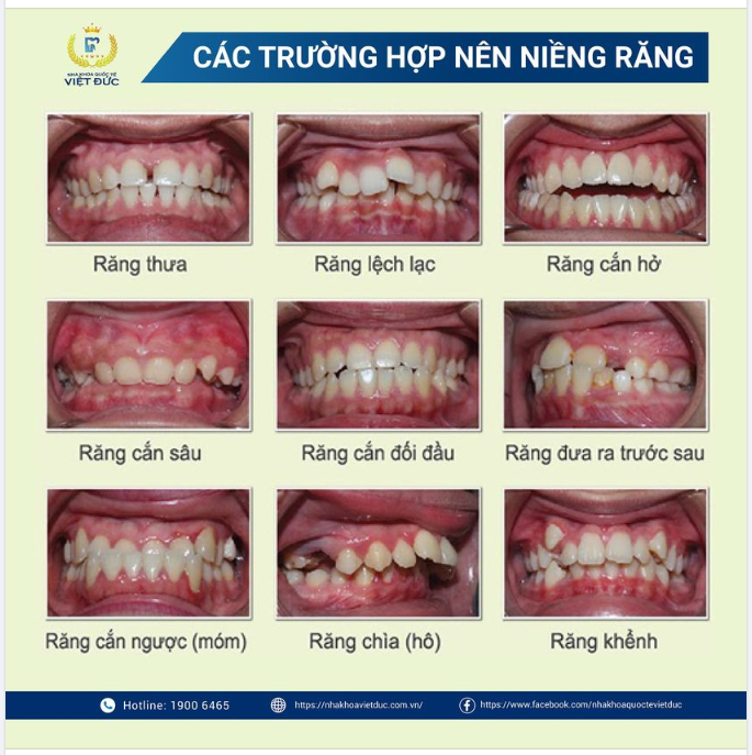 TÌNH TRẠNG RĂNG HIỆN TẠI CỦA BẠN ĐANG THẾ NÀO?