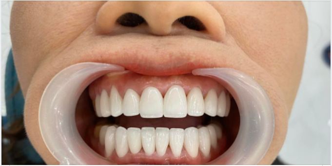 Tình trạng răng khó như thế nào các bác sĩ Delia cũng có thể xử lý toàn diện, đảm bảo an toàn, thẩm mỹ nhất cho khách hàng