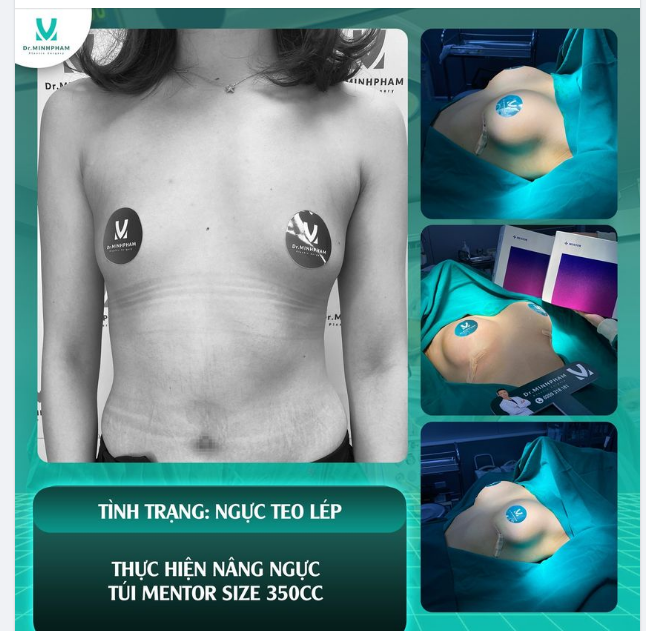 Tình trạng THIỂU SẢN TUYẾN NGỰ.C 90% các bà mẹ gặp phải sau quá trình sinh con.