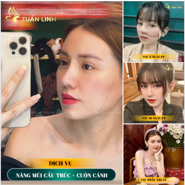 TỎA SÁNG CÙNG DÁNG MŨI CAO TÂY NHỜ NÂNG MŨI CẤU TRÚC ANGEL LINE TẠI TUẤN LINH