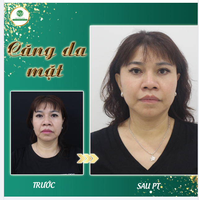 TRẺ HÓA CHỤC TUỔI CHO KH U60