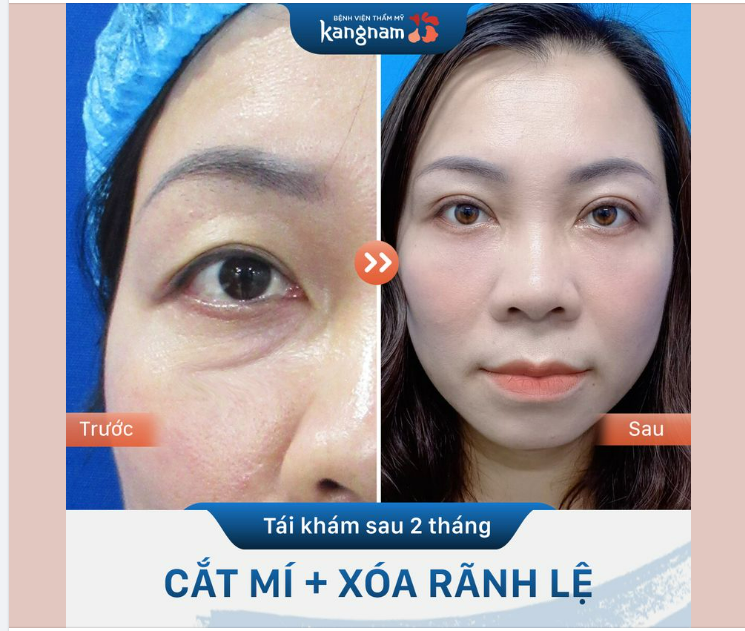 Trẻ hóa mắt với combo Cắt mí trên, dưới + Xóa rãnh lệ