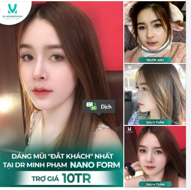 Trợ giá 10tr khi nâng mũi tại Dr. Minh Phạm