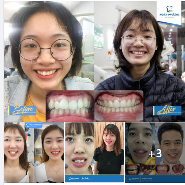 Trong mồm gì đẹp bằng răng Cứ không chen chúc là duyên nụ cười