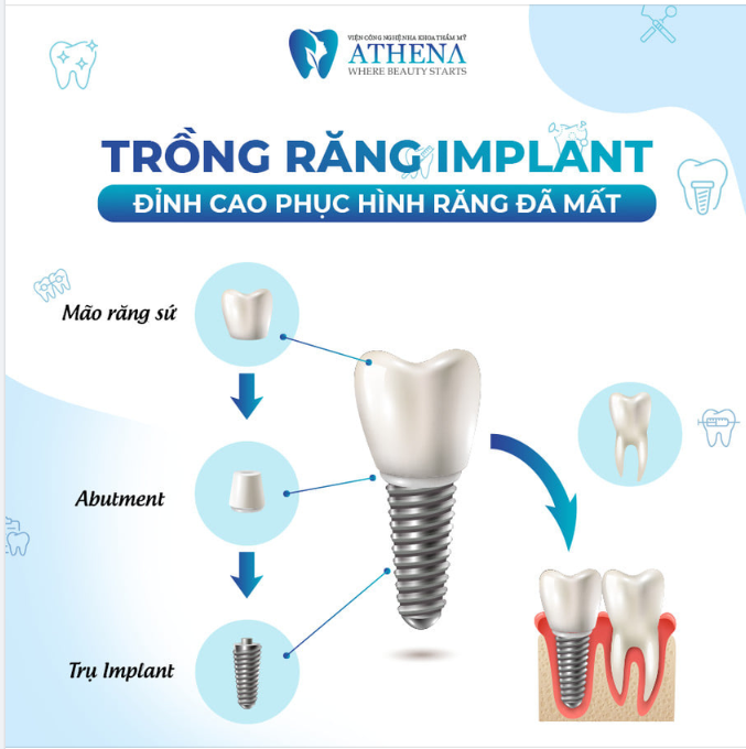 TRỒNG RĂNG IMPLANT - ĐỈNH CAO PHỤC HÌNH RĂNG ĐÃ MẤT