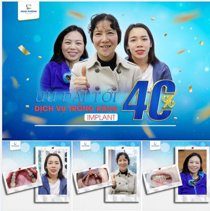 TRỒNG RĂNG IMPLANT, TẠI SAO LẠI KHÔNG