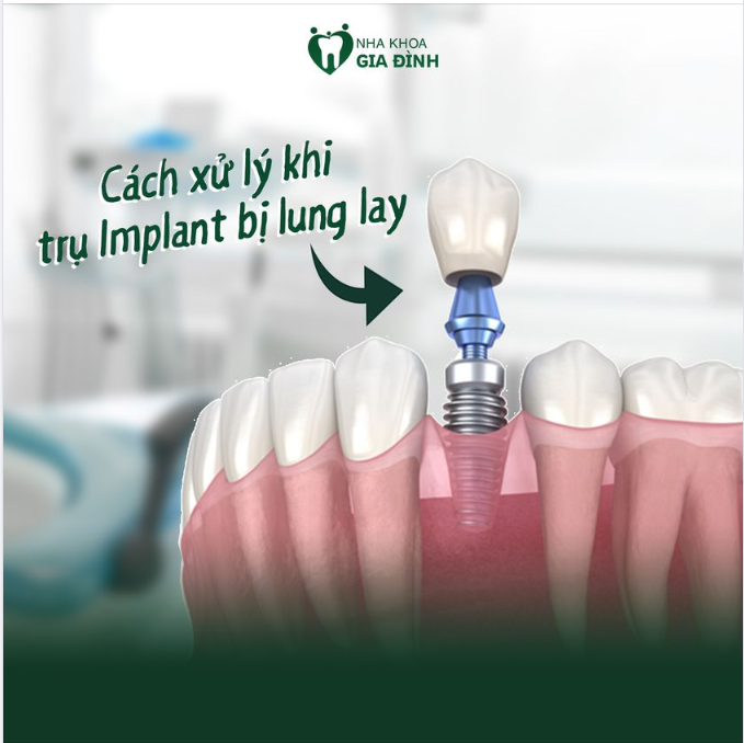 TRỤ IMPLANT LUNG LAY THÌ PHẢI LÀM SAO?