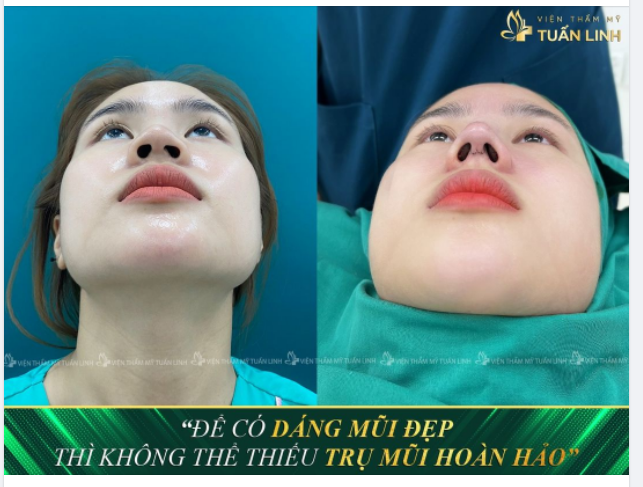 TRỤ MŨI CHẮC CHẮN GIÚP TẠO HÌNH DÁNG MŨI ĐẸP HOÀN HẢO