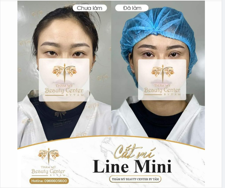 Trước khi Cắt mí - Mắt bé, có da chùng - Mí mắt hai bên không đều - Mắt trái không có mí, gặp tình trạng nhược cơ mí