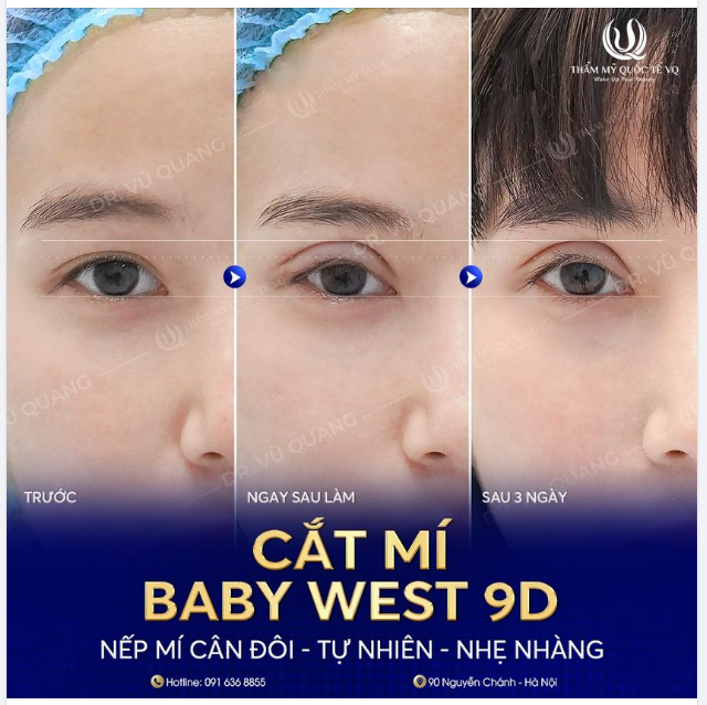 Trước khi cắt mí mọi người cứ bảo sẽ đau. Trước khi cắt mí mọi người cứ bảo sẽ thâm tím. Trước khi cắt mí mọi người cứ bảo sẽ phải nghỉ dưỡng