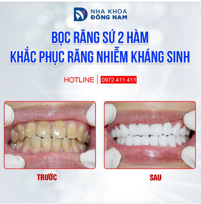 TỰ TI, CẢN TRỞ THÀNH CÔNG VÌ RĂNG Ố VÀNG LOANG LỔ TRONG NHIỀU NĂM