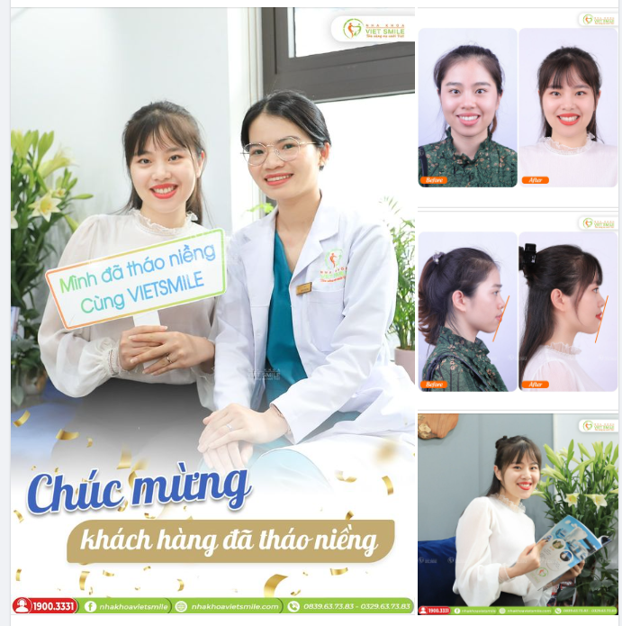 TỰ TIN HƠN, GÓC NGHIÊNG ĐẸP HƠN SAU 2 NĂM NIỀNG RĂNG HÔ