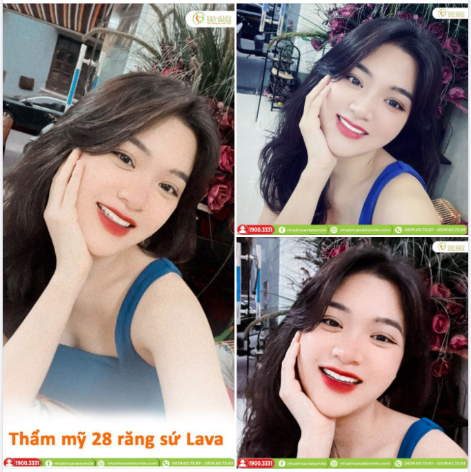 TỰ TIN KHOE NỤ CƯỜI XINH VỚI RĂNG SỨ LAVA 3M