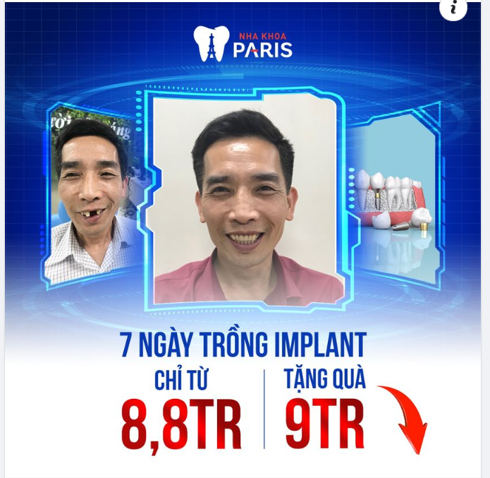 TUẦN VÀNG TRỒNG RĂNG NHẬN NHIỀU ƯU ĐÃI.